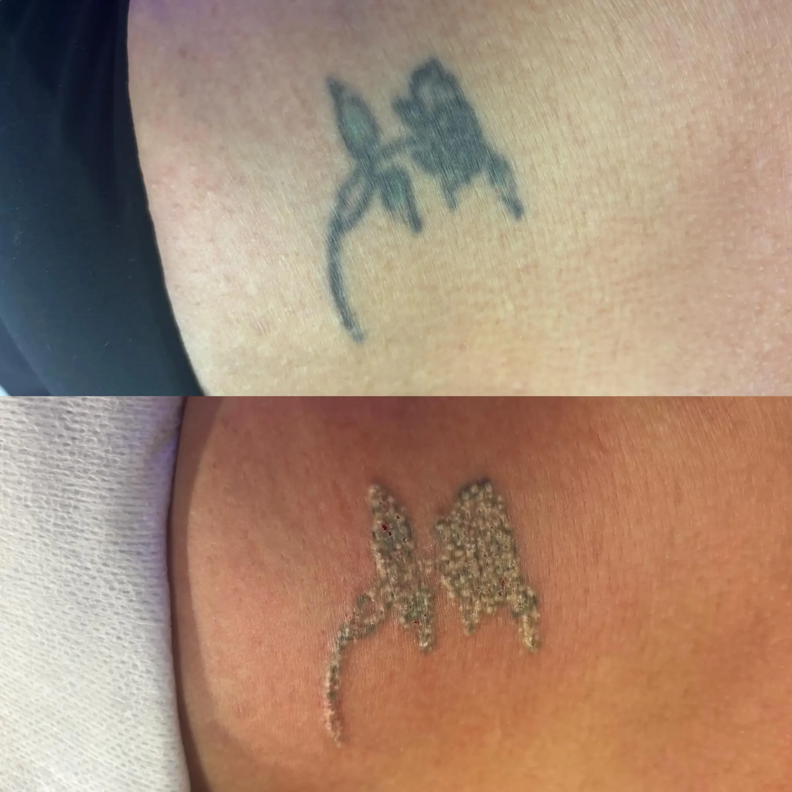 cost of laser tattoo removal -scaled