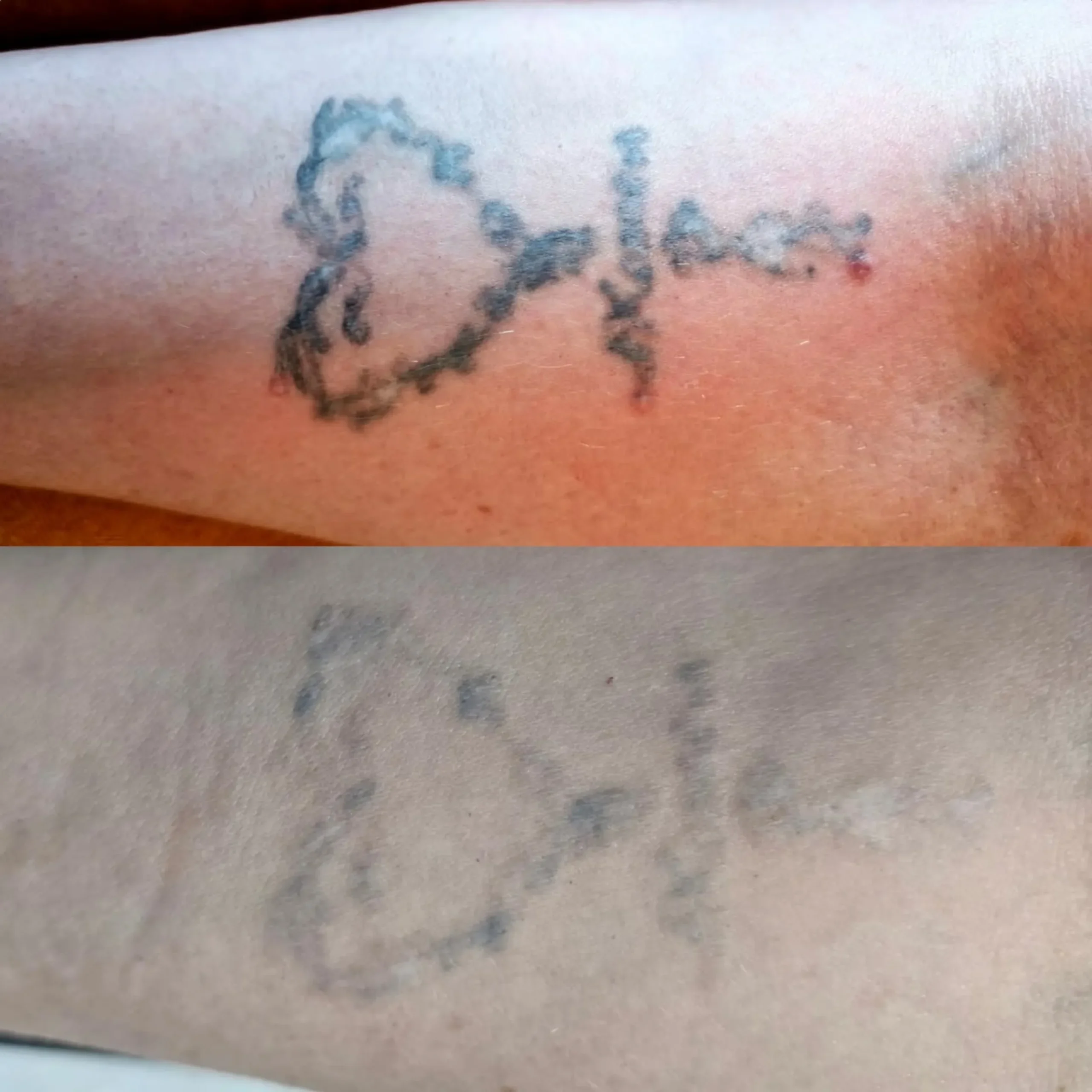 tatoo removal cost scaled