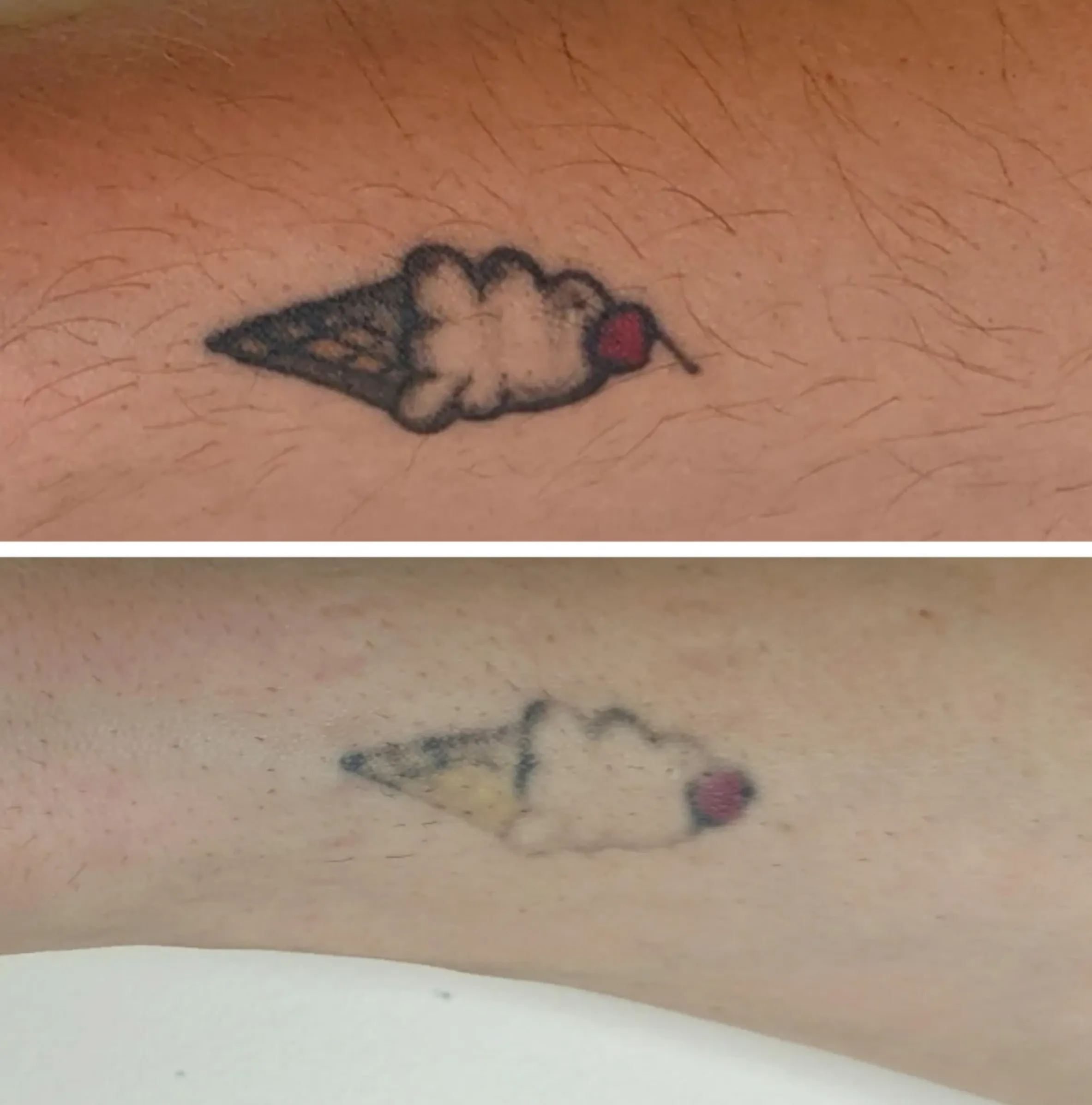 tattoo removal